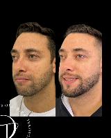 Cicatriz de Acne