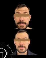 BOTOX MASCULINO – Cuidado com sua imagem, sem perder sua identidade.