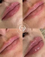 Preenchimento Labial