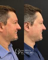 BOTOX MASCULINO – Cuidado com sua imagem, sem perder sua identidade.