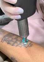Remoção de Tatuagem