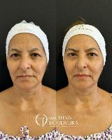 BOTOX – Um toque sutil que realça sua beleza natural!