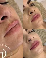 Preenchimento Labial