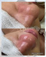 LIMPEZA DE PELE PROFUNDA – Sua pele merece esse cuidado!