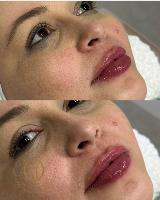 Preenchimento Labial
